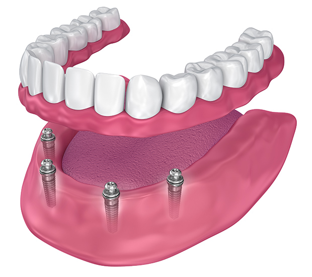 Coral Gables All-on-4 Implants