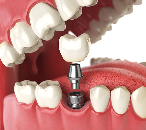 Coral Gables Will I Need a Bone Graft for Dental Implants