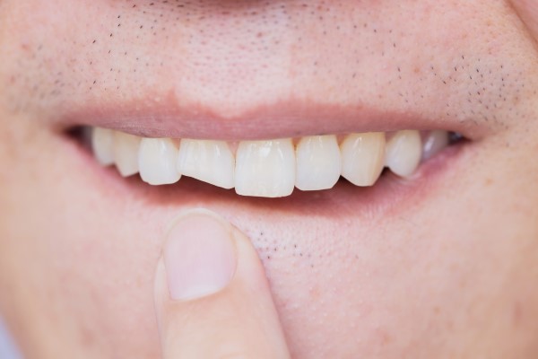 Prevent Further Damage Of A Chipped Tooth