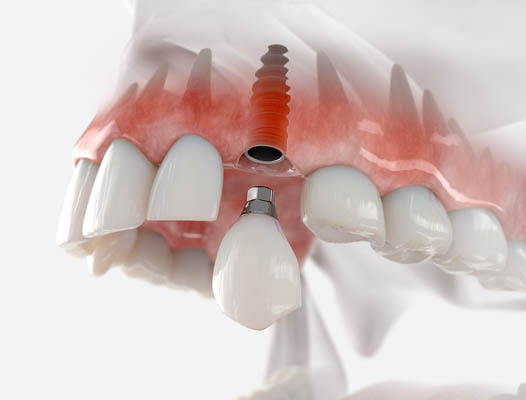 Dental Implant Coral Gables, FL