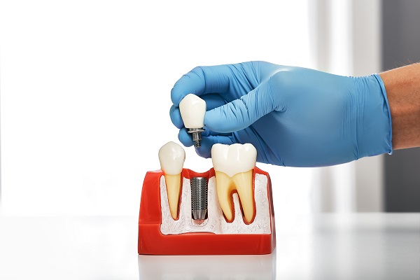 Dental Implants Coral Gables, FL